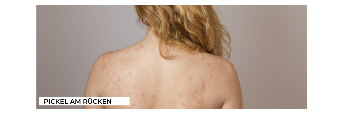Darum bekommen wir Pickel am Rücken und das können wir dagegen tun  - Pickel am Rücken  mit CMD Naturkosmetik loswerden