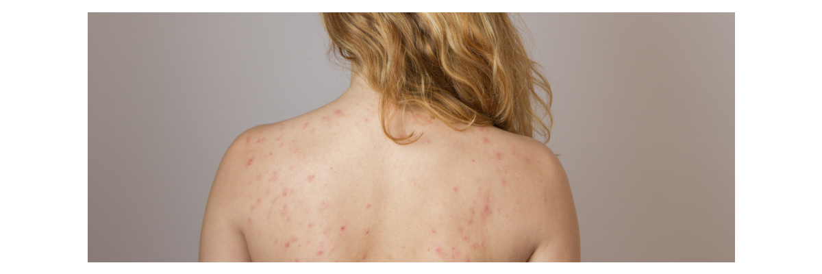 Darum bekommen wir Pickel am Rücken und das können wir dagegen tun  - Pickel am Rücken  mit CMD Naturkosmetik loswerden